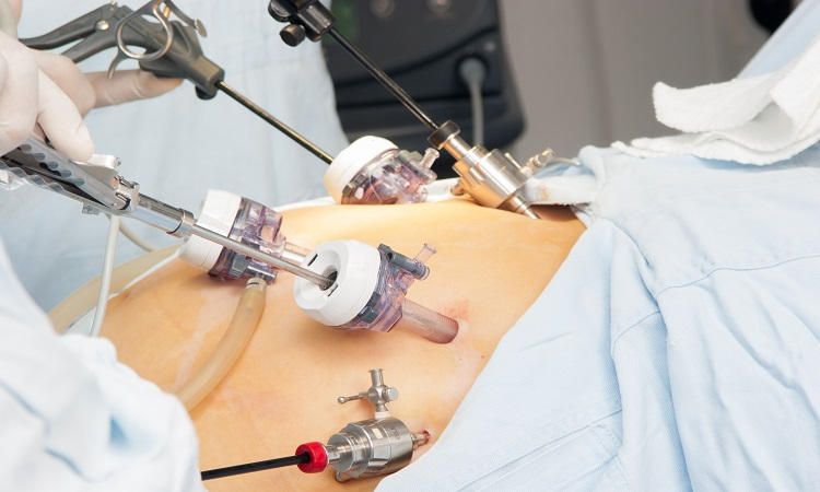 Laparoscopic Gynecological Surgeries